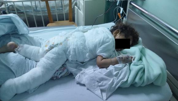 Bebé sufre quemaduras en su cuerpo