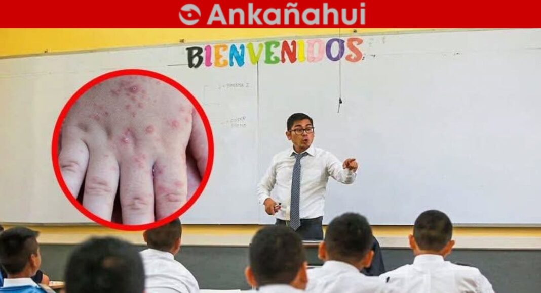 ugel-piura-casos-virus-coxsackie-colegios.jpg